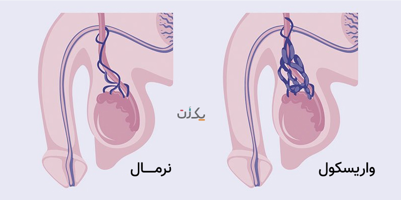 چرا واریکوسل میگیریم